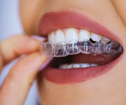 Invisible Braces Tirupati